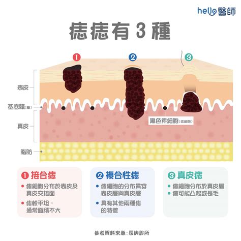 痣 生成原因|為什麼會長痣：解析痣的成因與注意事項